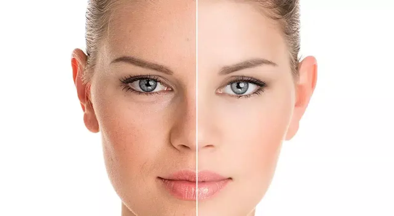 Peeling Médical