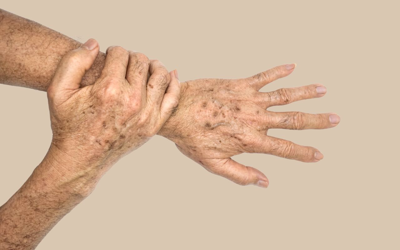 Laser Lésions Pigmentaires