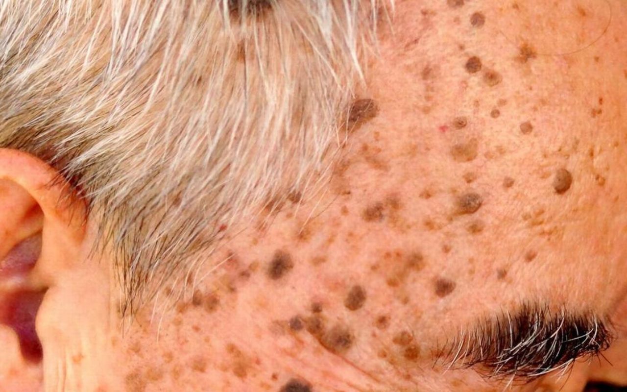 Laser Lésions Pigmentaires