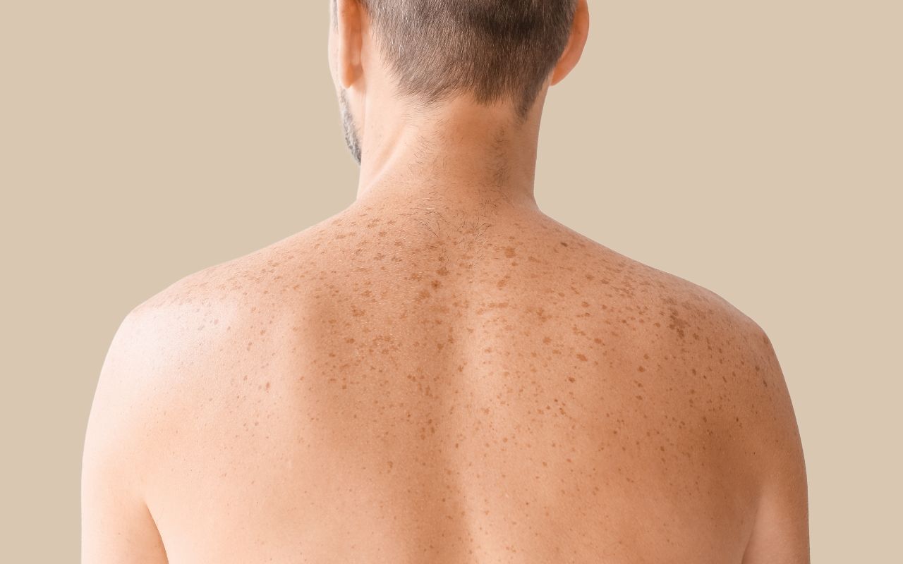 Laser Lésions Pigmentaires