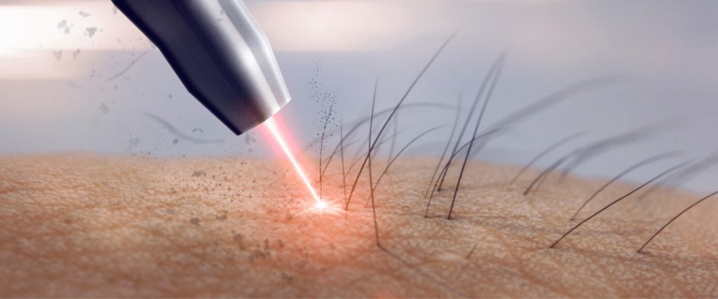 Epilation laser définitive
